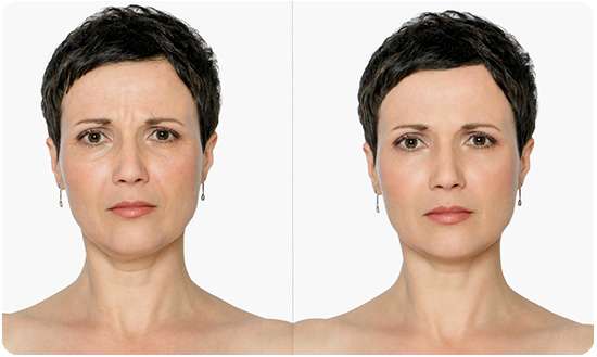 Женщина до и после применения маски Cledbel