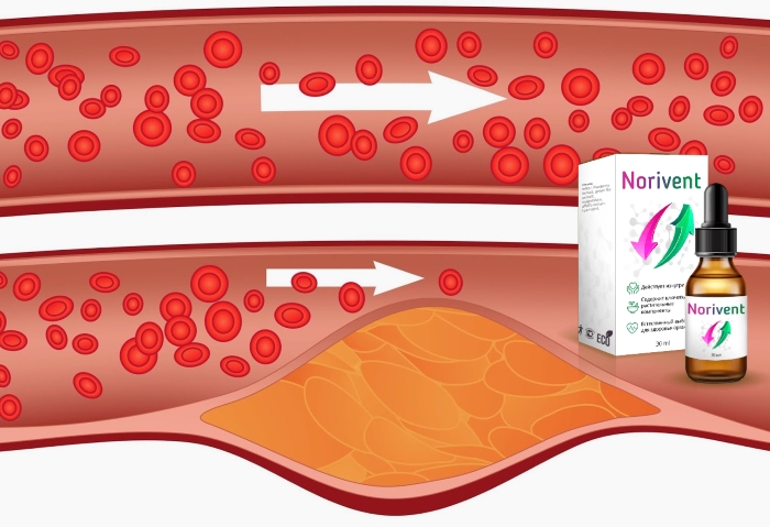 Как действует средство NORIVENT (Норивент) от холестерина и как пользоваться