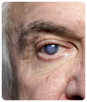 Проблема с глазом до применения лекарства Oculminex.