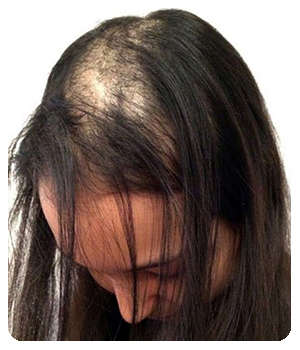 Выпадение волос до применения капсул Voloperfo.